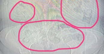  Midesinden uyuşturucu çıkan şahıs tutuklandı