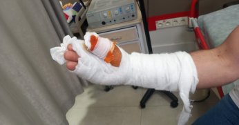 “Basit kesi” kabusa döndü: Parmağını kaybetti
